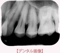 長崎 諫早市 諫早ふじた歯科・矯正歯科 CTと従来のレントゲンの比較