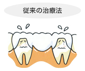 長崎 諫早市 諫早ふじた歯科・矯正歯科 周りの健康な歯を削ってブリッジにします。