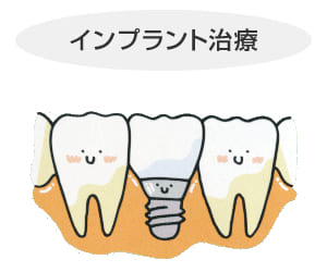長崎 諫早市 諫早ふじた歯科・矯正歯科 健康な歯をまったく削ることなく、歯のない部分にインプラントを入れます。