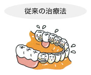 長崎 諫早市 諫早ふじた歯科・矯正歯科 入れ歯を固定するための針金が、見た目にも機能的にも不快です。