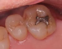 長崎 諫早市 諫早ふじた歯科・矯正歯科 さて、それでは歯の溝と歯と歯の間にむし歯ができたとします。一般的にはむし歯をしっかり取りきり、型取りをしてこうのような銀の詰め物（銀歯）が入ります。