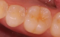 長崎 諫早市 諫早ふじた歯科・矯正歯科 まず、ここに健康な歯があります。
むし歯というのも、なりにくい部位となりやすい部位があります。年齢や歯の種類などによっても変わってきますが、一般に歯の溝（噛みあわせの部分）や歯と歯の間に出来やすいです。