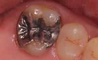 長崎 諫早市 諫早ふじた歯科・矯正歯科 二次的にむし歯になってしまった銀歯はやりかえないといけません。すると、また大きく削りますので銀歯の面積は大きくなるのです。