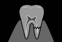 長崎 諫早市 諫早ふじた歯科・矯正歯科 これを繰り返していくと、残りの歯は少なくなってきます。