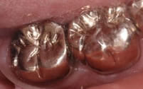 長崎 諫早市 諫早ふじた歯科・矯正歯科 その銀歯の詰め物の面積がどんどん大きくなるとどうでしょう。今度はむし歯が神経まで蝕んでしまいます。