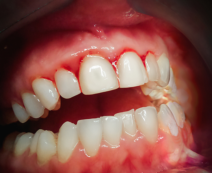 長崎 諫早市 諫早ふじた歯科・矯正歯科 歯周病菌　除菌治療は保険外治療です