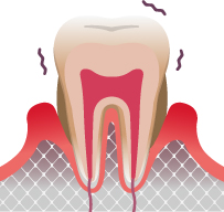 長崎 諫早市 諫早ふじた歯科・矯正歯科 歯周病菌が全身に及ぼす影響