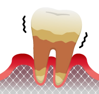 長崎 諫早市 諫早ふじた歯科・矯正歯科 歯周病と糖尿病は相互に関係