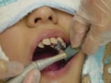 長崎 諫早市 諫早ふじた歯科・矯正歯科 PMTCでバイオフィルムを破壊し、歯の表面に薬剤が浸透しやすい環境を作ります