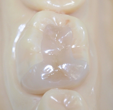 ふじた歯科　歯医者　セラミック　インレー　虫歯　白い歯