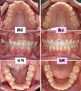 矯正　術前術後