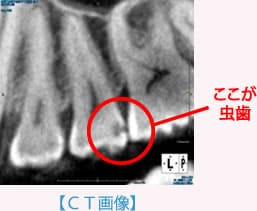 長崎県　諌早市　歯医者　ふじた歯科　CT画像