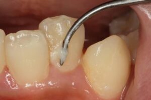 歯医者　プラーク　歯周病