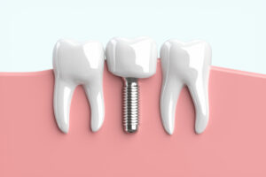 歯医者、歯科、インプラント、フッ素、虫歯、歯周病