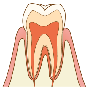 虫歯の治療について