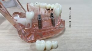 インプラント と さし歯の違い