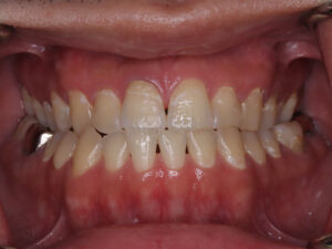 初期虫歯の特徴と治療方法