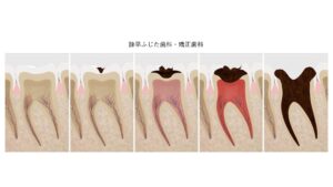 虫歯の進行度別の症状・治療法・費用
