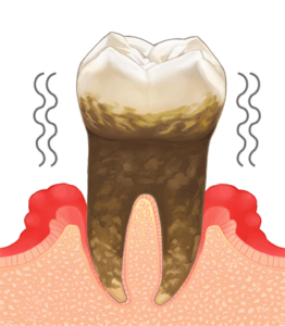 歯周病と全身疾患
