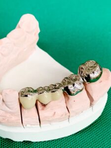 なぜ虫歯の治療に銀歯？