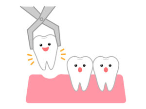矯正治療での抜歯、その判断基準とは？
