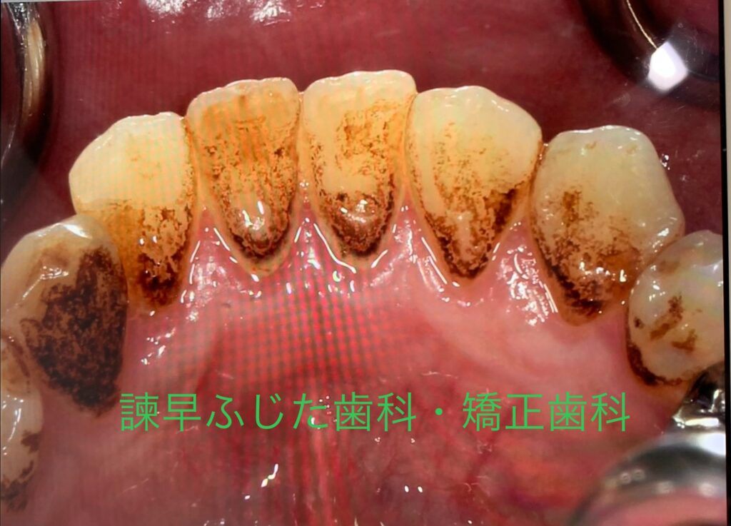 ステイン　歯医者　ふじた歯科　着色