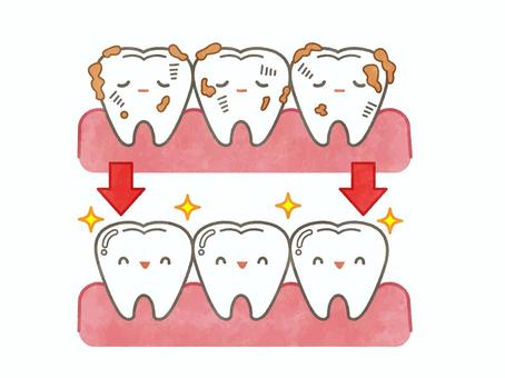 矯正中の虫歯と歯周病治療