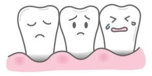 歯肉退縮と妊娠中の歯周病について