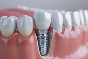 インプラントとブリッジ、どちらがよい？