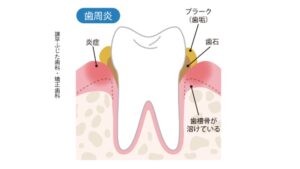 軽度歯周病