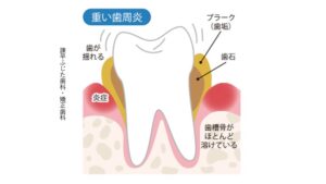 重度歯周病
