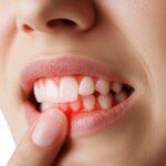 インプラント治療後に歯茎が腫れた女性の口元