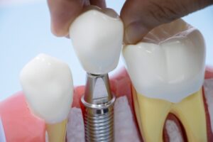 インプラントと入れ歯の違い