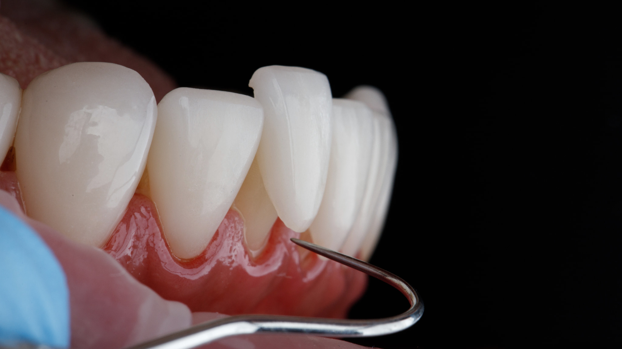 セラミック治療の一種であるラミネートベニアのイメージ