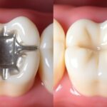 銀歯とセラミックの歯のイメージ
